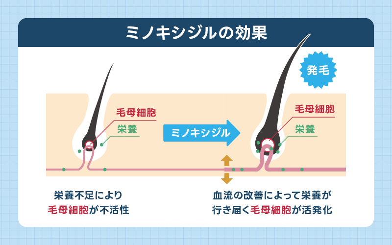 ミノキシジル 効果