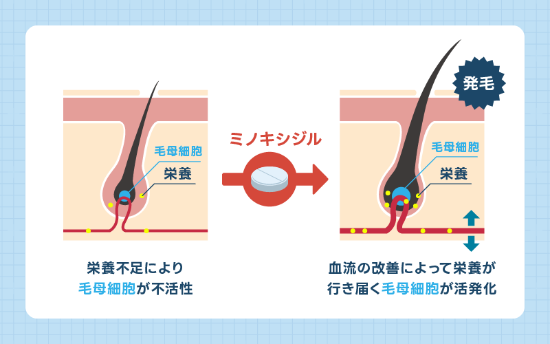 ミノキシジル 効果